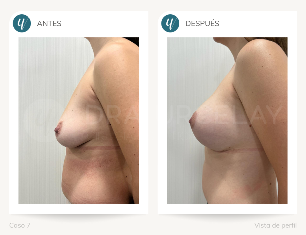 Doctora Urcelay, resultado de cirugía de elevación mamaria