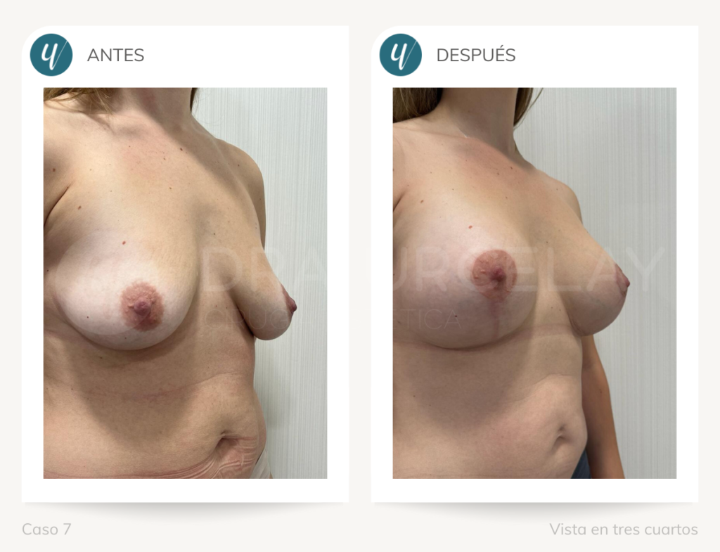 Doctora Urcelay, resultado de cirugía de elevación mamaria