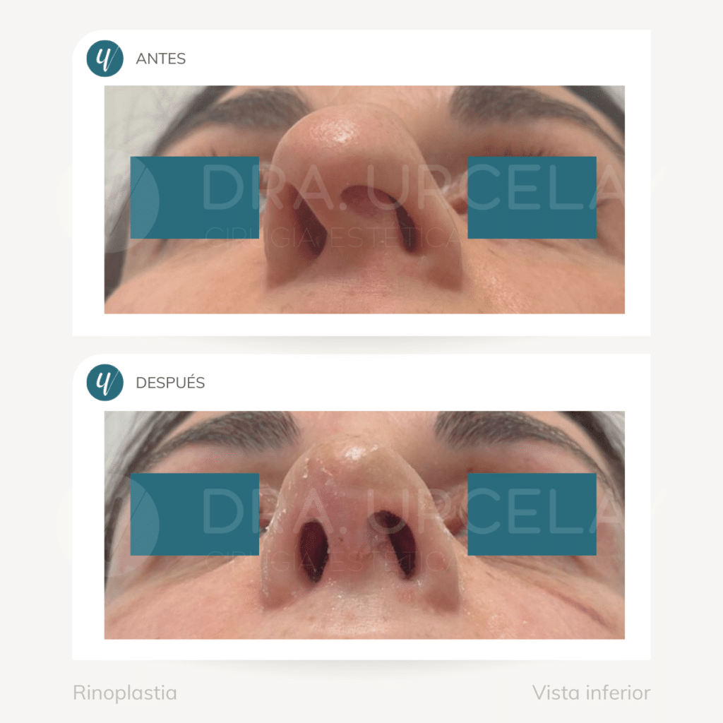 Rinoplastia en vista inferior