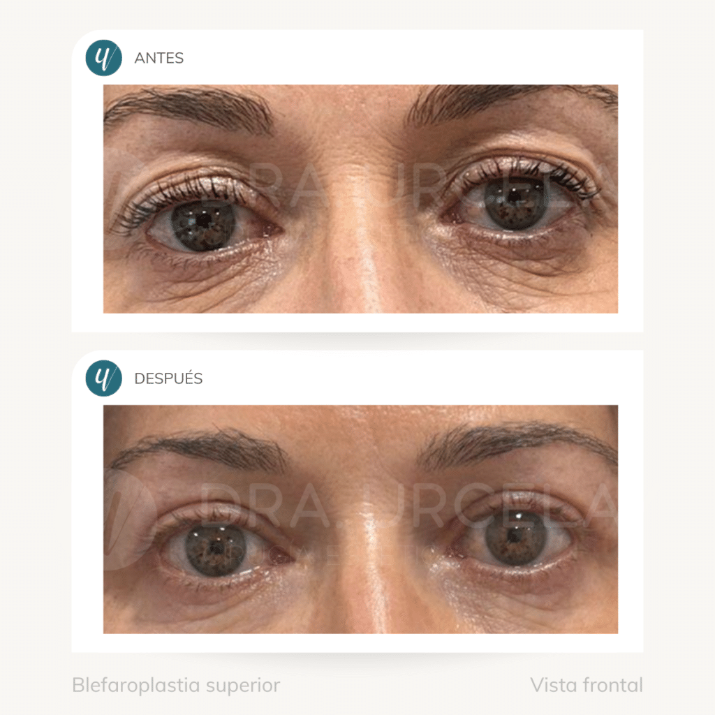 Blefaroplastia superior antes y después en Madrid