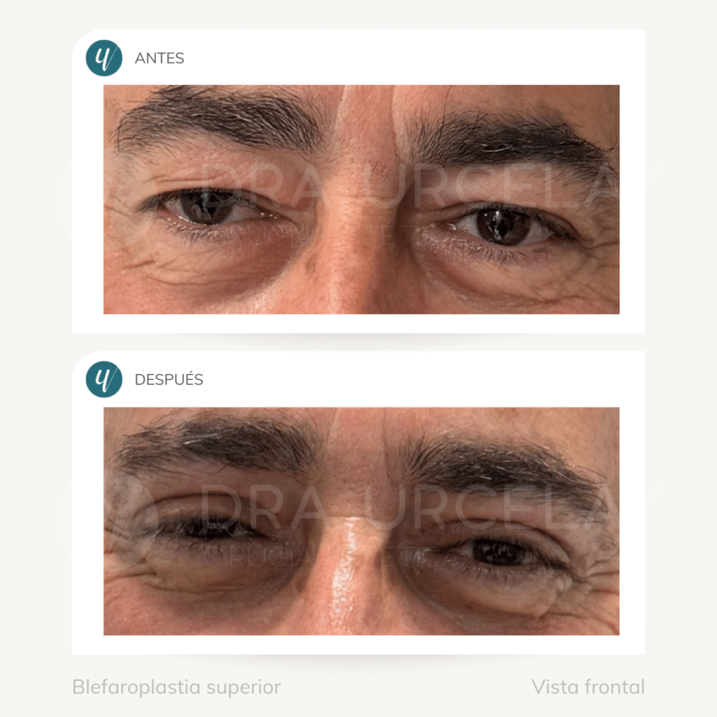 Blefaroplastia superior en Madrid