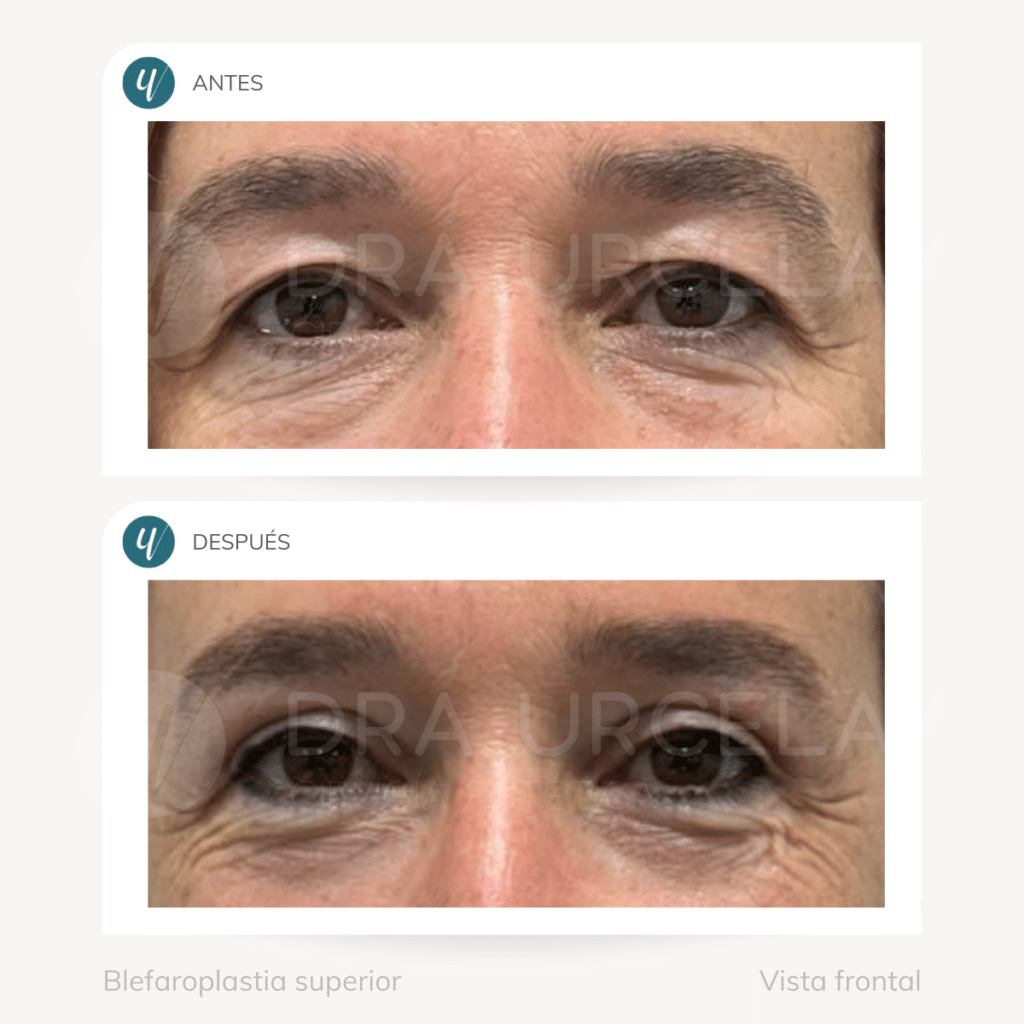 Cirugía de blefaroplastia superior en Madrid