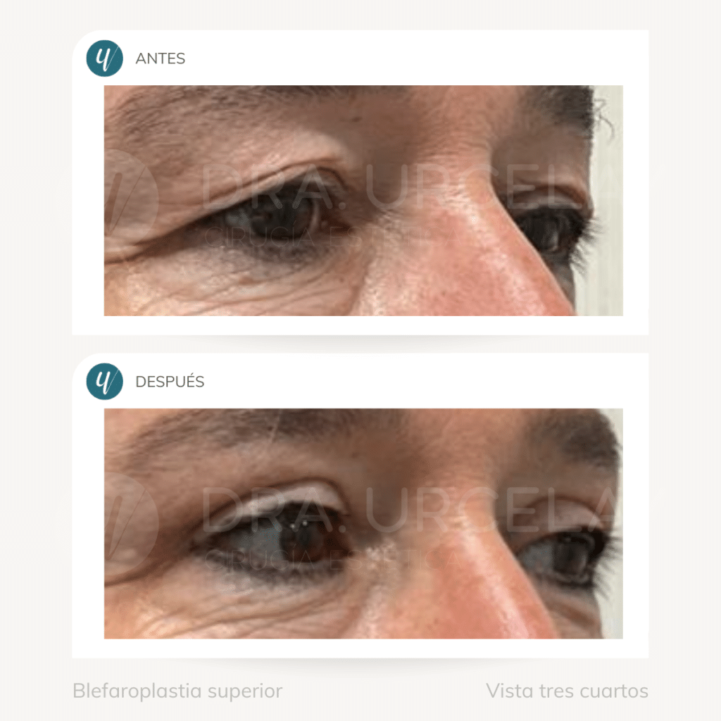 Cirugía de blefaroplastia superior en Madrid