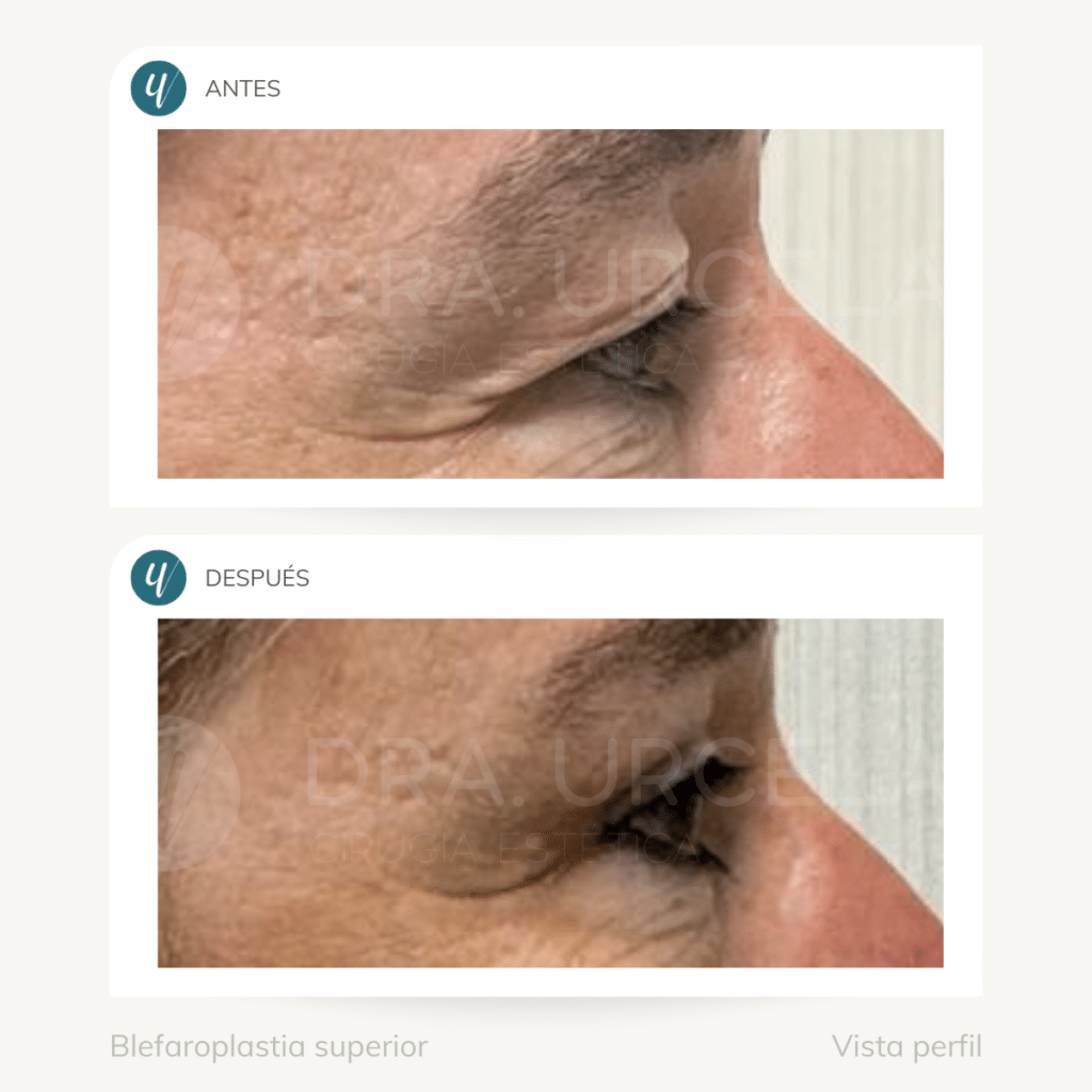 Cirugía de blefaroplastia superior en Madrid